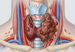 Cancers thyroïde