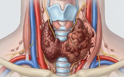 Cancers thyroïde