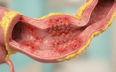Maladie de Crohn