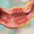 Maladie de Crohn