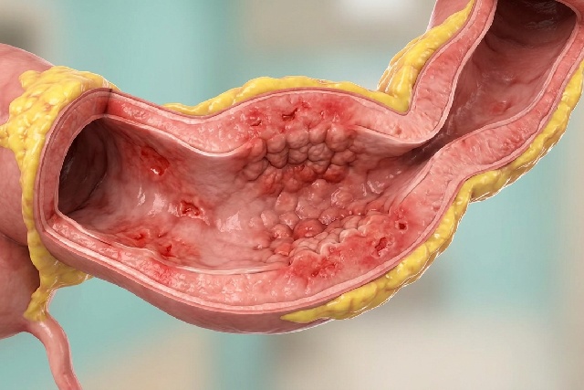 Maladie de Crohn